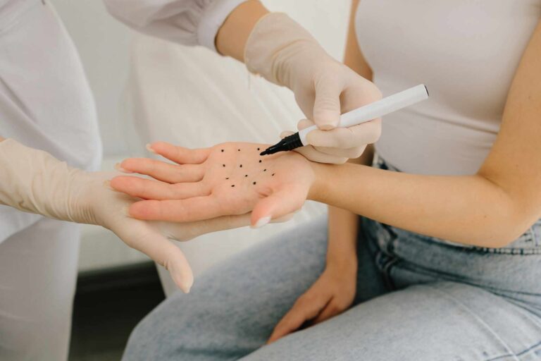 Marking dots on palm for filler injection to treat hyperhidrosis